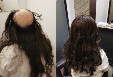 Hair Replacement SG Hair Replacement SG